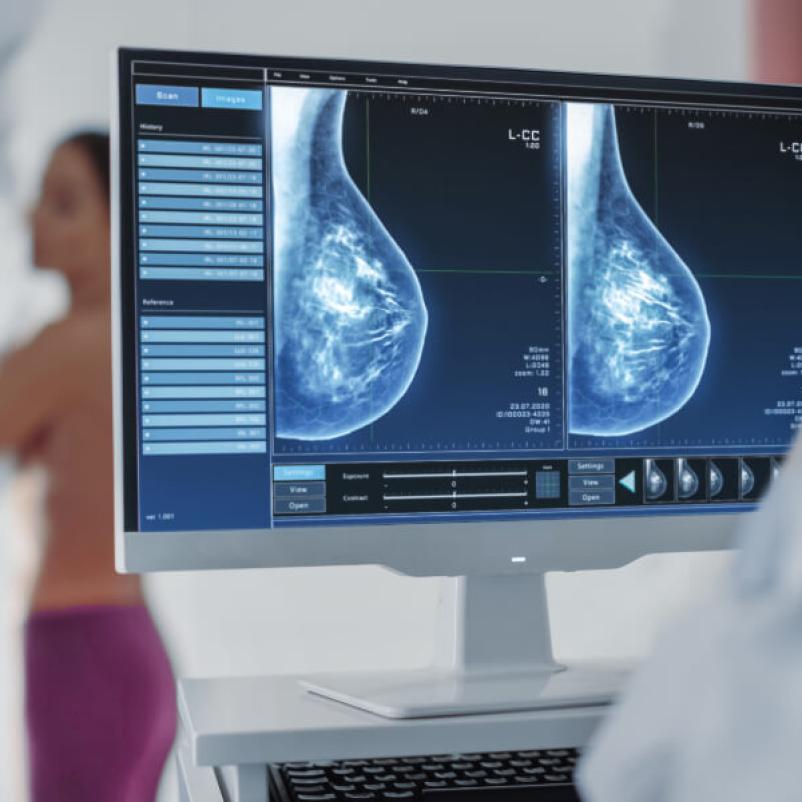 Mammografie beeld op computer